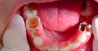 دانت کا درد ہو یا کیڑا لگ جائے ، ایک چیز منہ میں ڈال کر گھماؤ